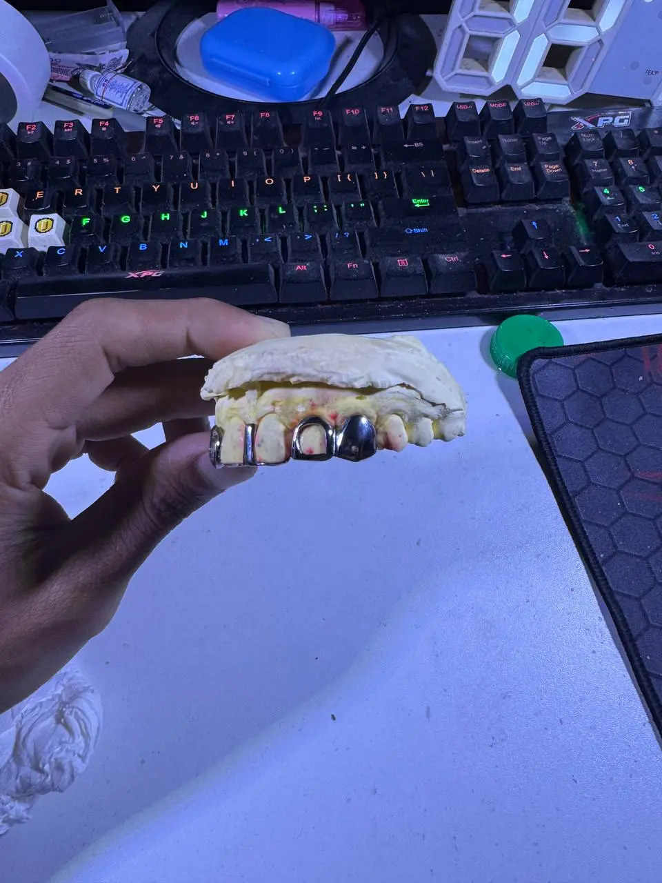 Detailed view of Custom Set grillz dental jewelry